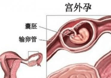 宫外孕腹腔镜手术后护理